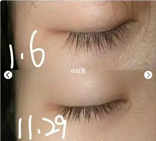 改善眼袋仅980元不开刀让你更出众,消除眼袋细纹大概多少钱