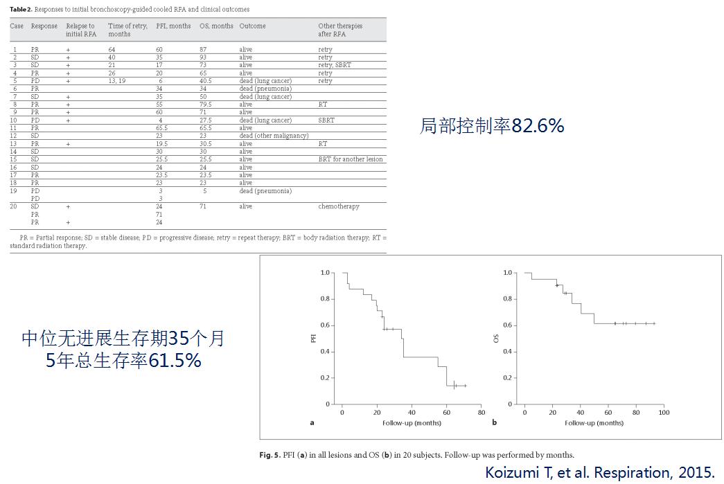 小细胞肺癌的气管镜介入治疗,导航支气管镜在肺癌诊断中的应用
