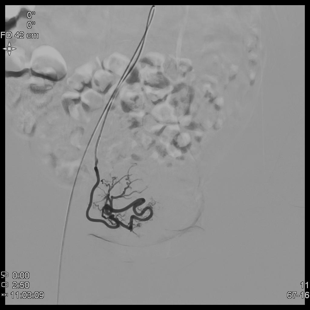 子宫腺肌症介入栓塞全国哪里好,子宫腺肌症介入栓塞治疗报销吗