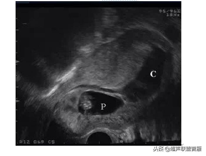 剖宫产疤痕妊娠动画,剖宫产疤痕妊娠的临床分型