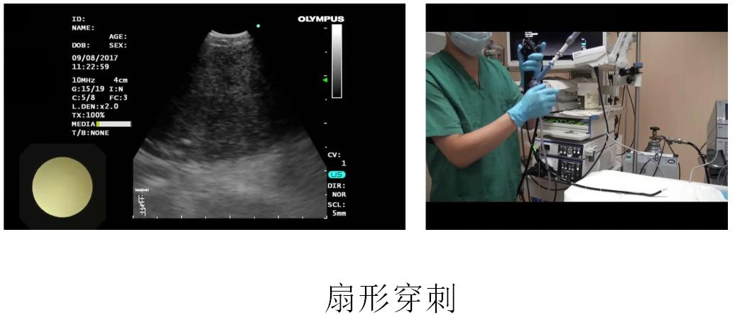支气管镜高频电刀治疗中央型肺癌,支气管镜在早期肺癌诊断的意义