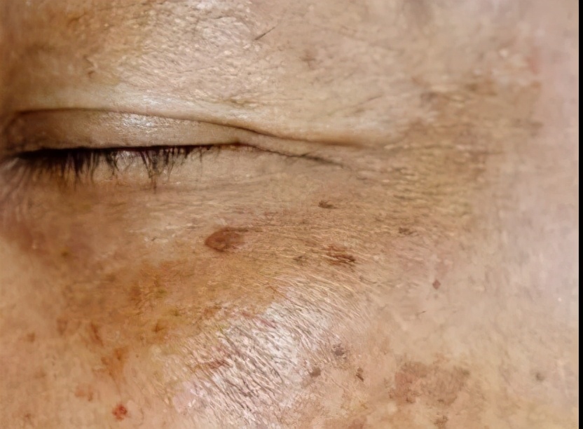 祛除老年斑的最好方法,祛除老年斑的办法