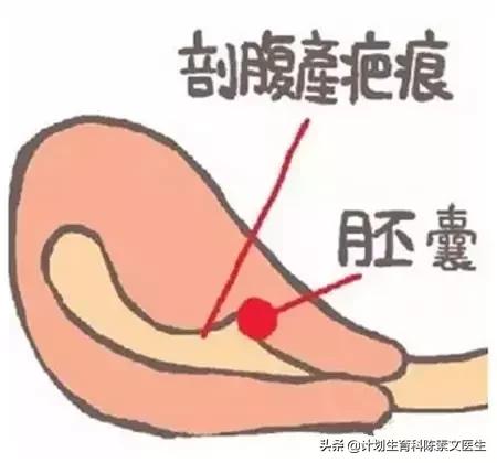 切口妊娠的孩子能要吗,什么叫切口妊娠介入治疗