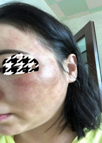 一次水光针需要2000多针吗,一次水光针等于100片面膜