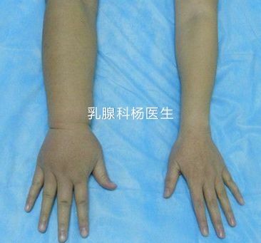 乳腺癌患者是怎么染发的,乳腺癌如何预防淋巴水肿