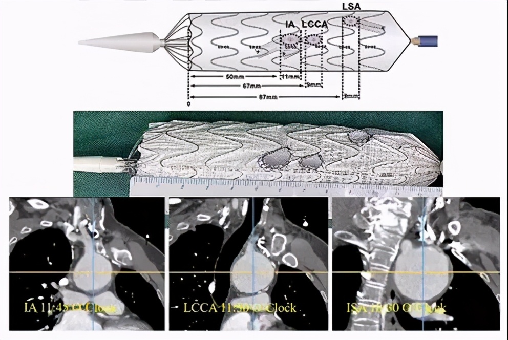 胡佳:升主动脉近端手术后新发弓部病变的腔内治疗