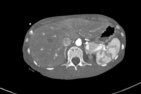 重度高碳酸血症突出表现,出现消化系统疾病的临床表现