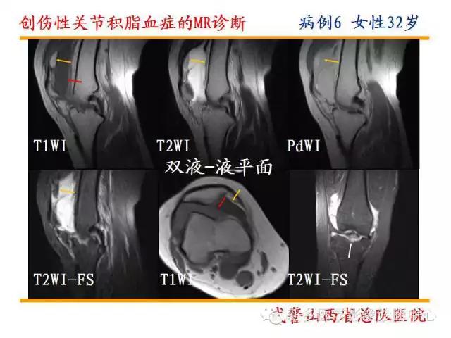 膝关节炎髌上囊积液自己看得出吗,髌上囊有积液膝盖会走路无力吗
