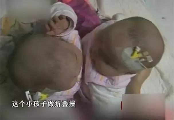 坐骨连体女婴现在状况,坐骨连体姐妹分离成功了吗