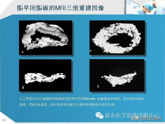 骨骺损伤x线表现,骨骺损伤磁共振表现