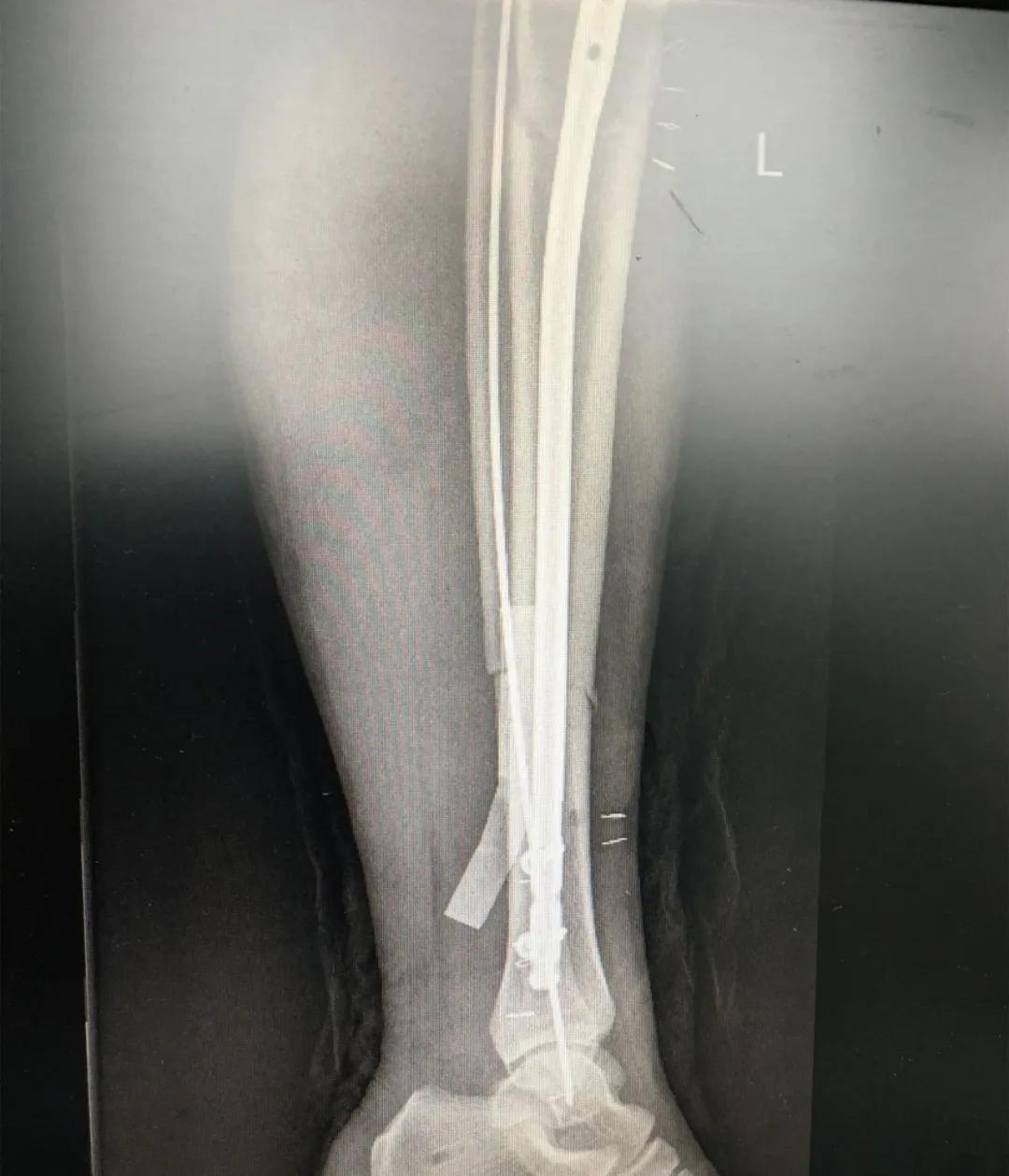 小腿骨断成三截了还能恢复吗,小腿断了三截能好彻底吗