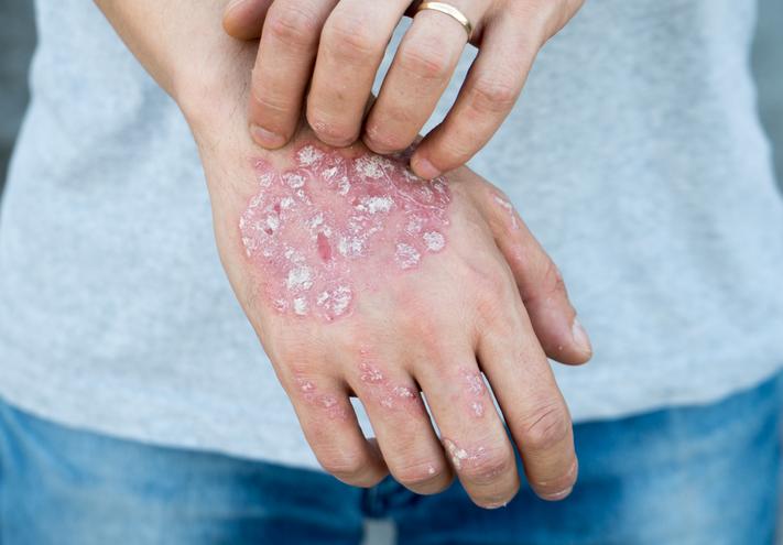 皮肤又红又痒又肿是什么原因,皮肤一抓就红而且凸起还痒怎么办