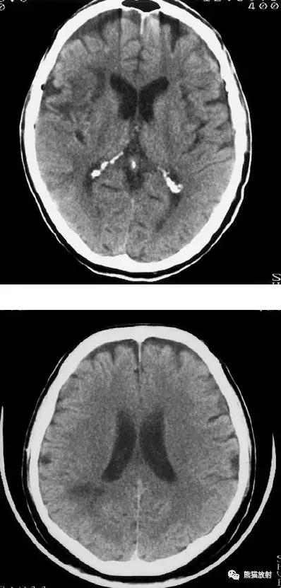 各部位脑梗死ct影像讲解,脑梗死ct影像最简单的是什么表现