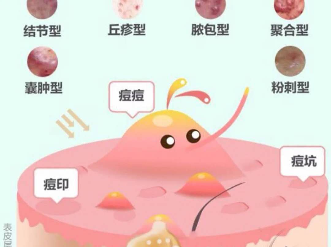 又红又硬又痛的是什么痘,痘痘没挤变硬了一定是结节痘吗