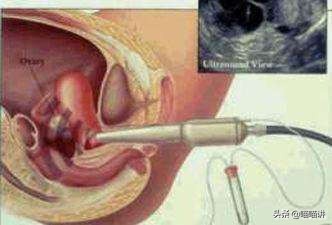 做阴式B超检查要注意什么？这三类人要远离，女性要提前了解