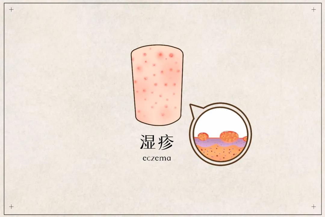 宝宝湿疹应该忌口什么,外阴湿疹好了以后还用忌口吗