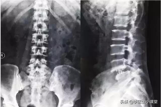 腰间盘突出症，除了药物治疗，康复锻炼是否可行？怎么做才正确？