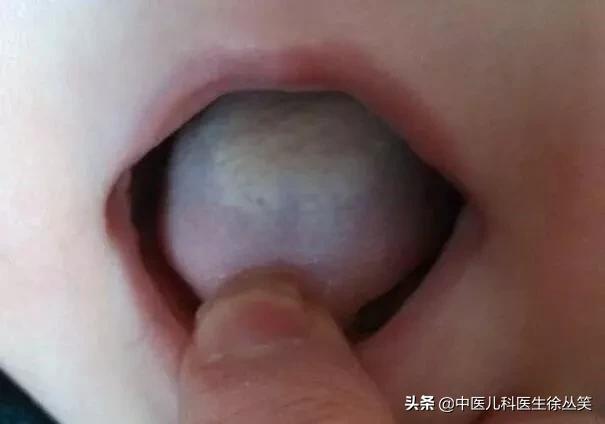 孩子积食怎么分辨寒还是热,小儿百病积食为先图片