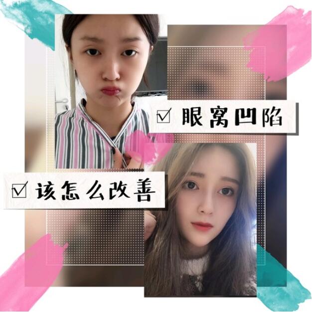 眼窝凹陷调理饱满,怎样判断眼窝凹陷还是深眼窝