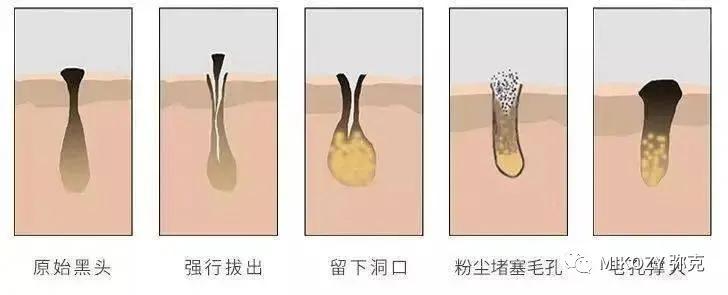 去除陈年深黑头,清理黑头哪家强