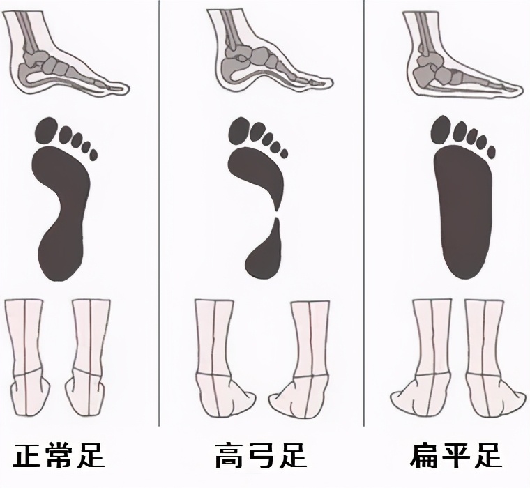 高弓足的保守锻炼治疗方法是什么,高弓足的表现和危害