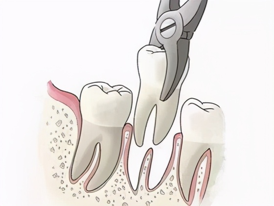 拔牙后什么时候冰敷什么时候热敷,拔牙前24小时冰敷24小时后热敷