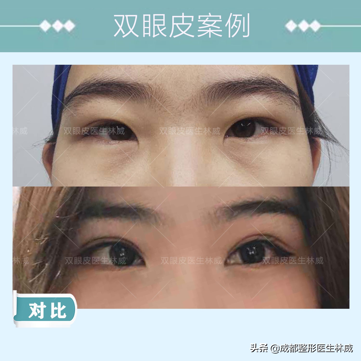 成都林威双眼皮多少钱,成都双眼皮林威医生