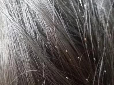 为什么会得阴虱虫,为何有人身上会长阴虱