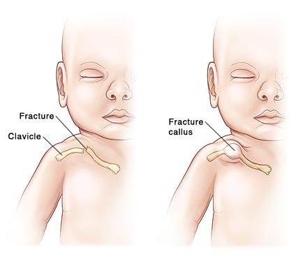 新生儿锁骨骨折医院一般怎么处理,新生儿锁骨骨折原因有哪些