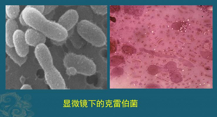 糖尿病人不要犟,有1种细菌喜欢喝糖浆,感染眼睛会失明