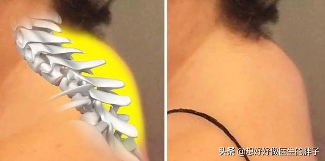 真相脖子后面的富贵包到底是什么,脖子上面的包是富贵包吗