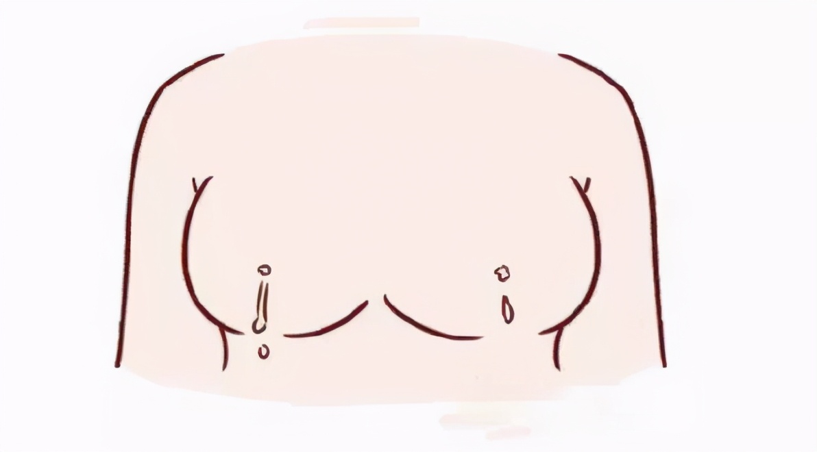 乳头溢液4年会得乳腺癌吗,乳头溢液可能是乳腺癌吗