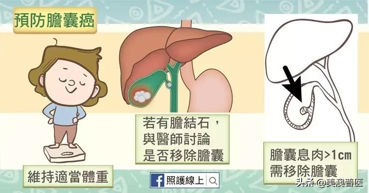 胆结石不治疗会拖成胆囊癌？有几点要特别注意