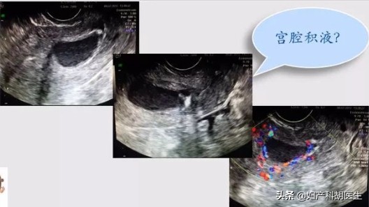 绝经后宫腔积液怎么治疗,怀孕了宫腔积液怎么治疗啊