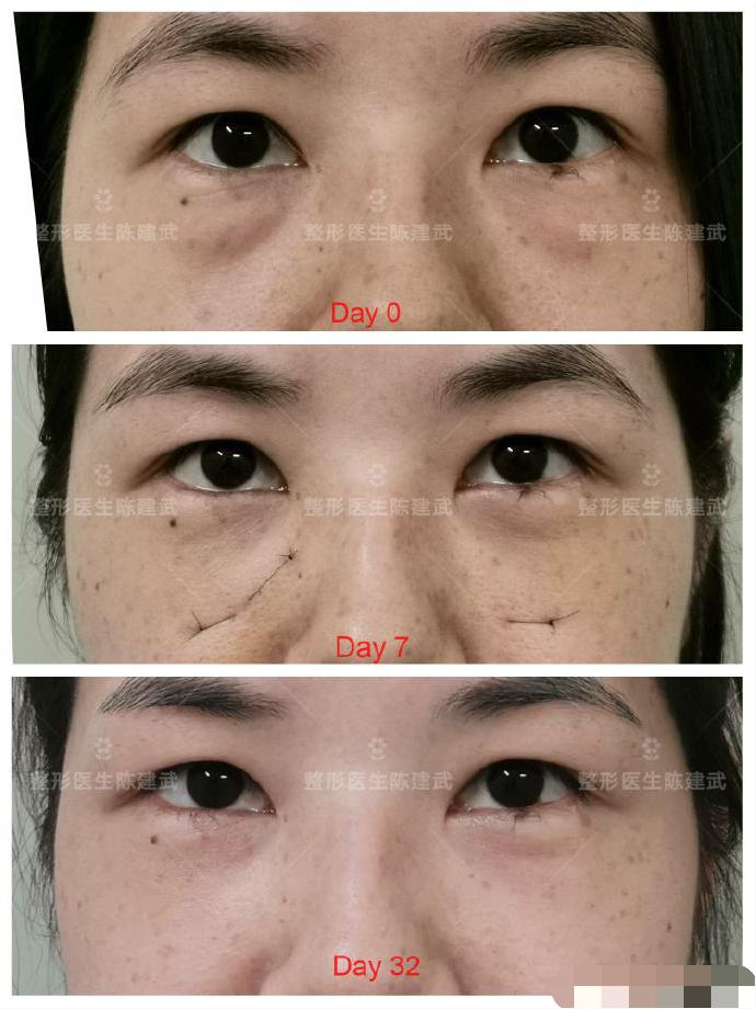 用盐和什么能去出眼袋,眼袋长肉粒怎么消除