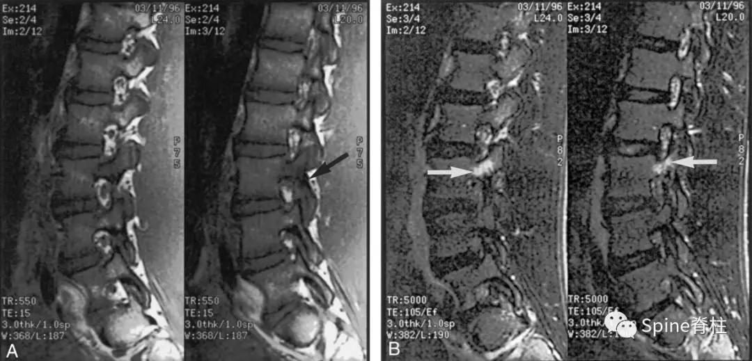 青少年一跑步就腰痛,青少年腰痛是什么原因引起的
