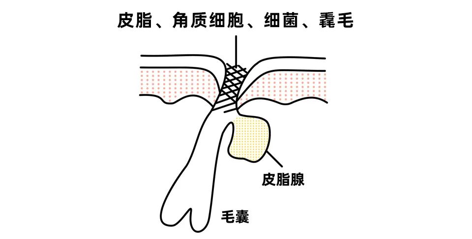 如何用简单的方法去黑头真实有效,别挤了教你去黑头的正确方法