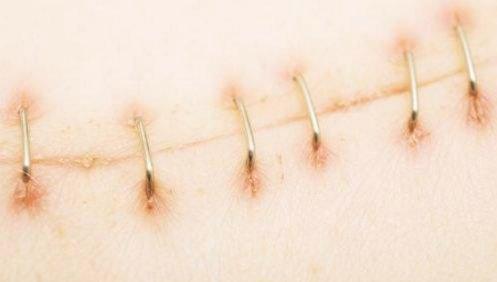 外伤缝合人工好还是订书机缝合好,骨科手术为什么用缝合钉