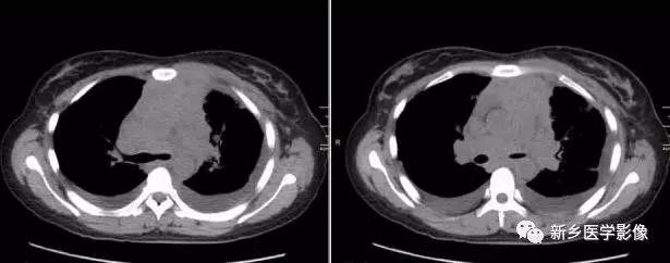 前上纵隔高密度影考虑胸腺未退化,肺纵隔胸腺结节12mm看什么科