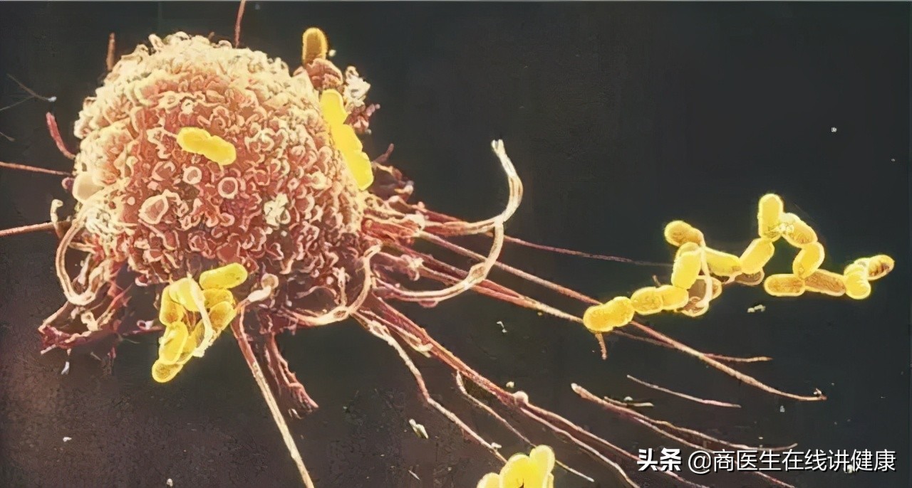 浸润癌是最严重的癌吗,浸润癌恶性