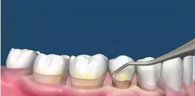 牙齿多久不刷会形成牙垢,牙齿背面没刷可以吗