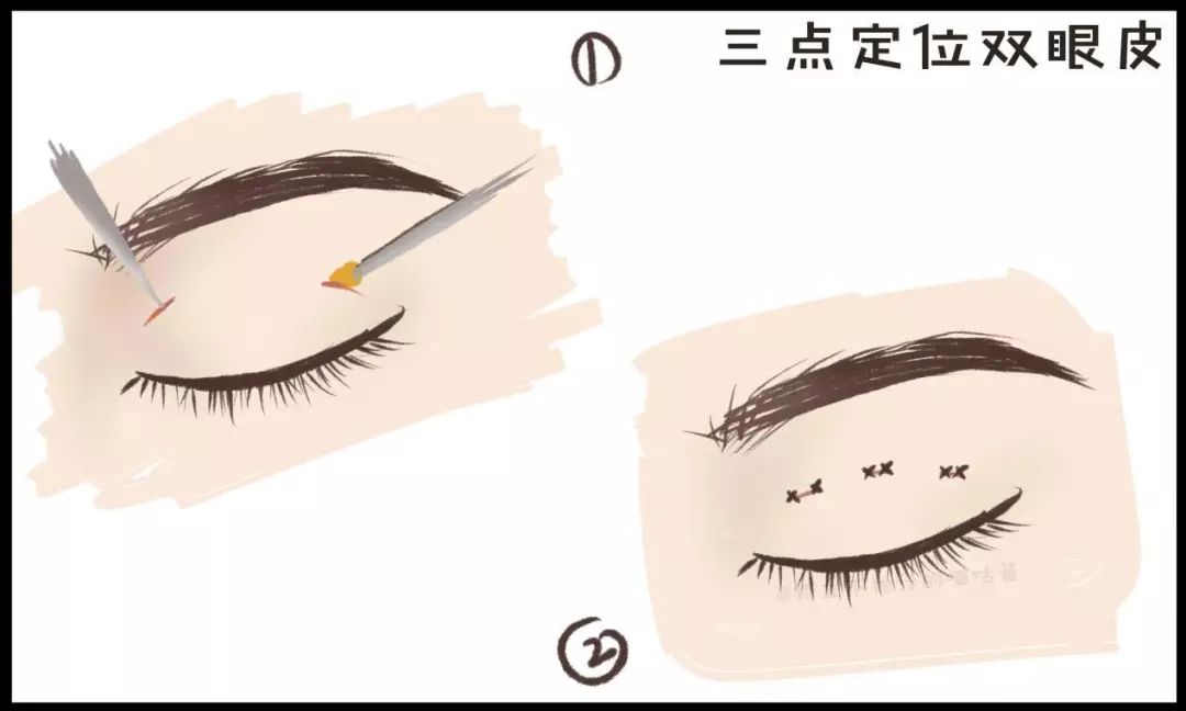 割双眼皮术前术后对比图,割双眼皮术前需要注意事项