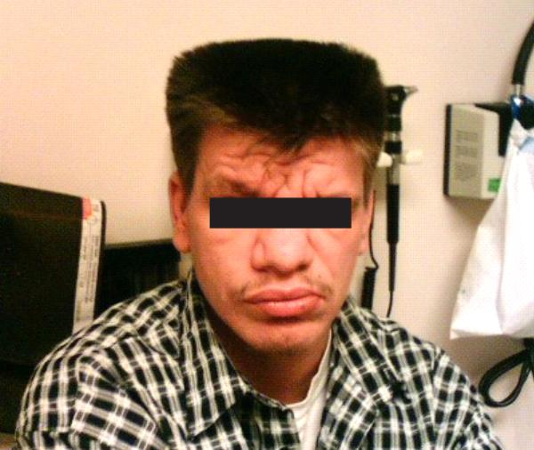 ige高引起湿疹,湿疹与特异湿疹有什么区别