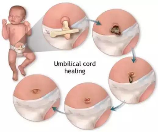 抠肚脐眼里的泥全过程,肚脐眼里的泥又多又硬能不能抠