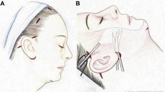 面部线雕跟超声刀哪个好,超声刀线雕和拉皮哪个效果好
