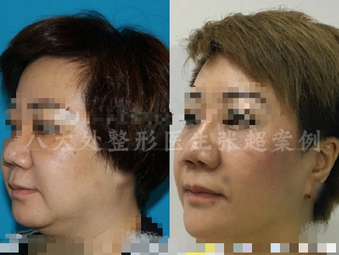 八大处整形张超,八大处张超最新视频