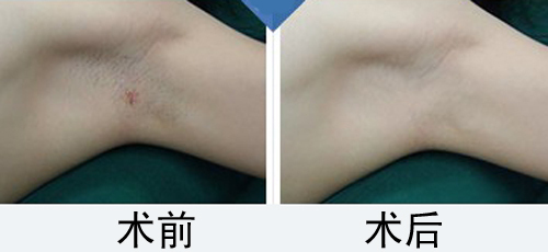 手术治疗狐臭需要住院吗,狐臭手术治疗费用多少