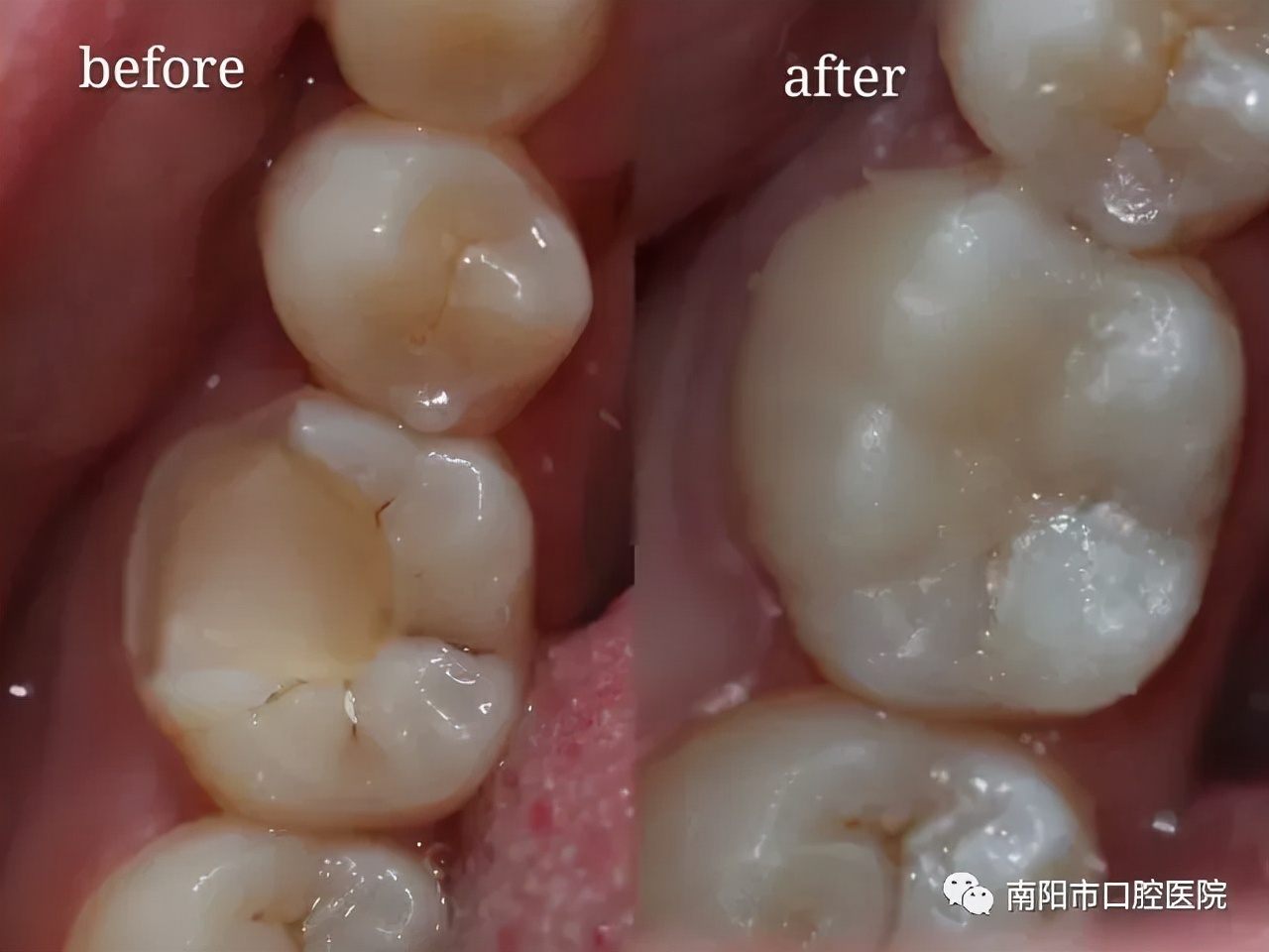 牙齿大面积龋坏牙冠都没了还疼,龋病牙体缺损的手术治疗
