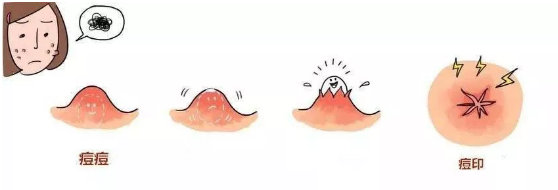 满脸痘痘和痘印怎么调理,痘痘痘印修复的最佳方法