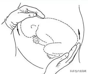 臀位变单臀位,矫正臀位的方法和技巧